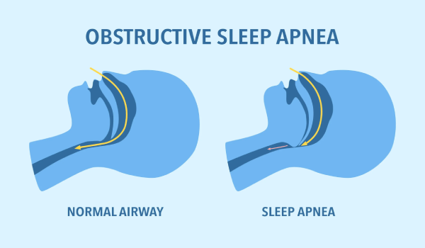 Anatomical diagram comparing an open airway vs. an airway obstructed by the tongue during sleep apnea